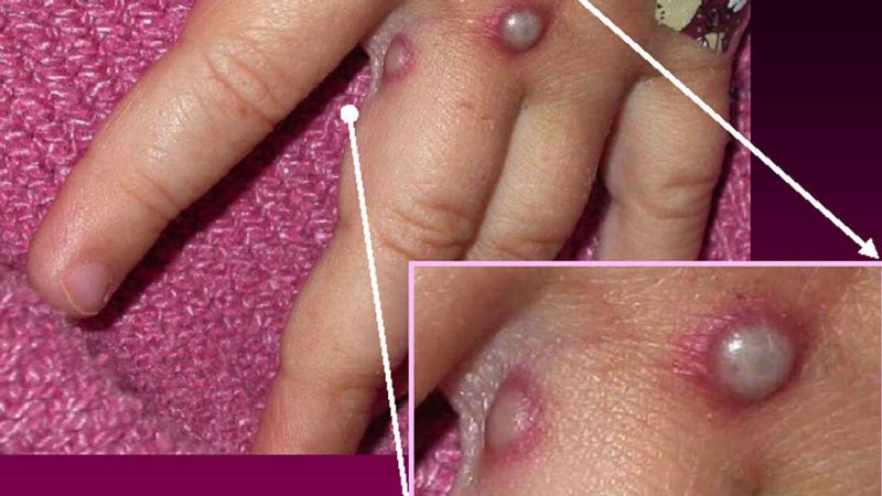 الصحة العالمية: 131 إصابة مؤكدة بجدري القرود و106 حالات مشتبه بها في 19 دولة